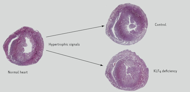 The hearts of mouse models deficient in Krüppel-like factor 4 (KLF4) protein show enhanced development of cardiac hypertrophy relative to control mice following stimulation by signaling molecules to induce the disease.