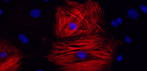 Cardiomyocytes derived from the reprogrammed cells of a patient with hypertrophic cardiomyopathy show augmented disarray in the presence of the hormone endothelin-1.