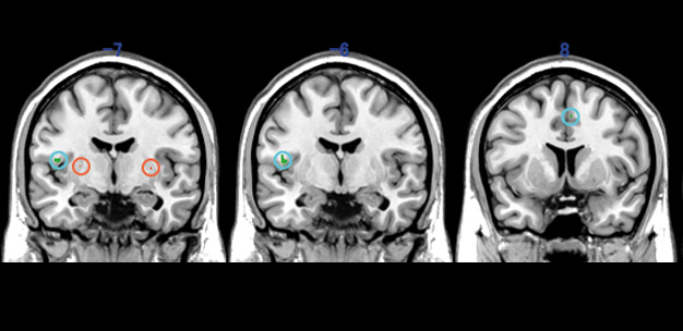Magnetic resonance imaging scans comparing volumes of gray matter in postural tachycardia syndrome (PoTS) cases with controls. Brain areas where people with PoTS have less gray matter than controls are shown in green. Areas where controls have less gray matter than people with PoTS appear in red.
