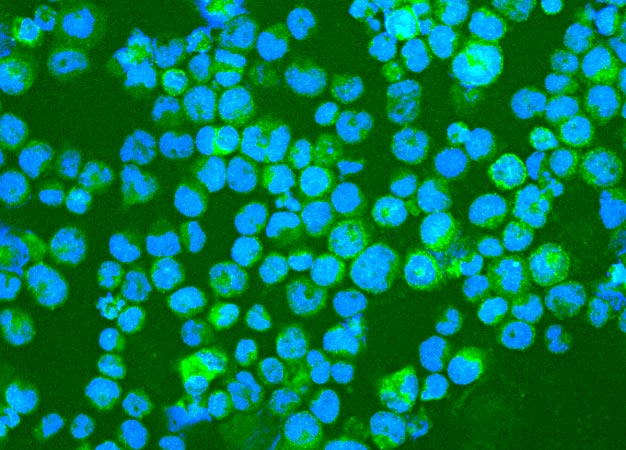 Leukemia cells expressing the surface protein PEPP2 (labeled bright green) that immune cells in the body can recognize.