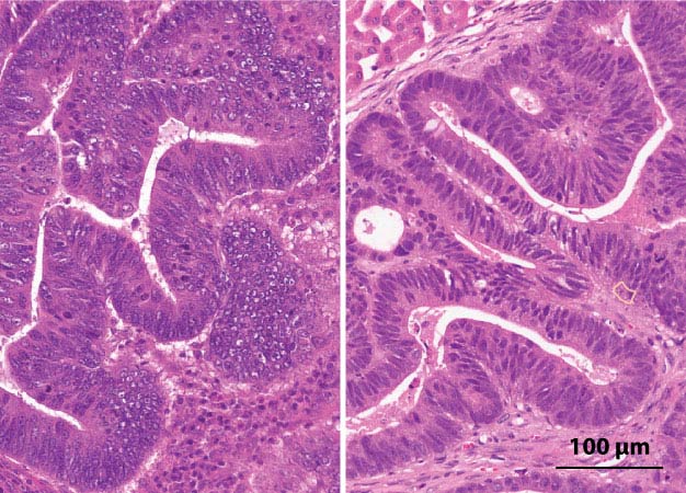 Three-dimensional tumors grown on a dish and transplanted into animal models (right) develop similar cellular structures as the original colorectal cancer cells taken from patient tumors (left).