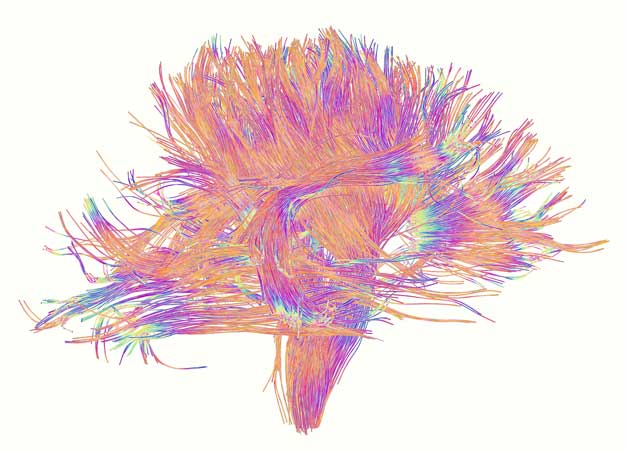 Improved models of the brain's communication network, known as white matter, could explain how diseases develop early in life.