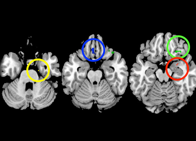 Mother-daughter similarities in the brain are most pronounced in regions involved in controlling emotion: the amygdala (red), gyrus rectus (blue), orbitofrontal cortex (green), parahippocampus gyrus (yellow), and anterior cingulate cortex.