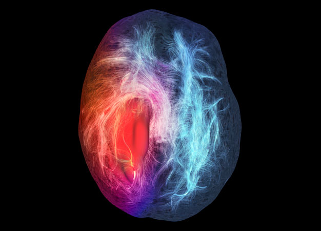 A magnetic resonance imaging scan showing nerve pathways around a glioblastoma (red) in the brain. Keio researchers have found how the drug bevacizumab improves blood vessels around such tumors but fails to eliminate cancer stem cells.