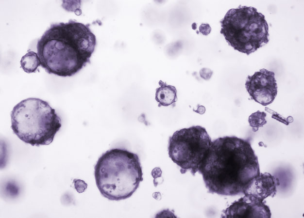 Three-dimensional organoids derived from human cholangiosarcoma tumor cells.