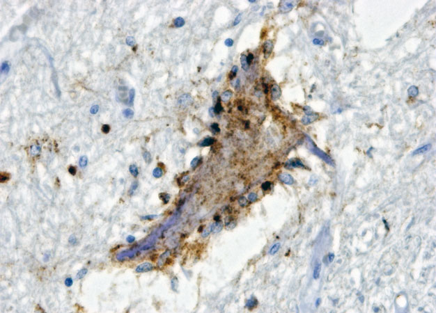 Motor neurons from a patient with ALS, where osteopontin is shown in gray. Blue indicates brain glial cells attacking the neuron.